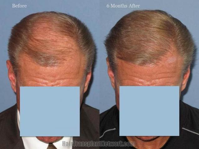 Top view - Before and after surgical hair replacement