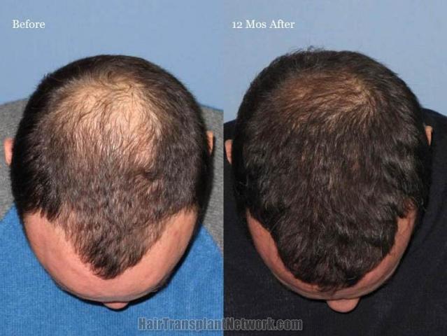 Top view before and after hair restoration results