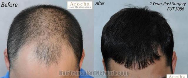 Hair restoration procedure before and after pictures