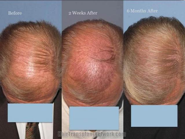 Hair restoration procedure before and after pictures