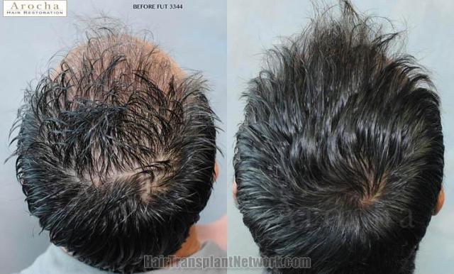 Hair restoration procedure before and after pictures