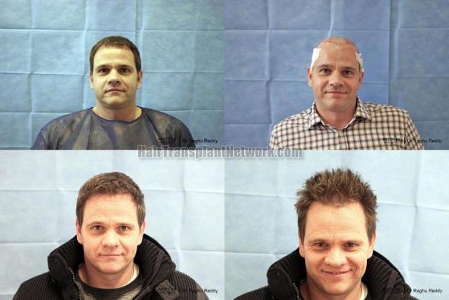 Hair transplantation surgery before and after pictures