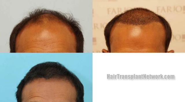 Hair restoration procedure before and after results