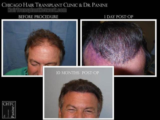 Hair restoration procedure before and after results