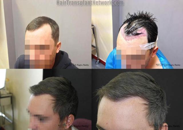 Hair transplantation surgery before and after images