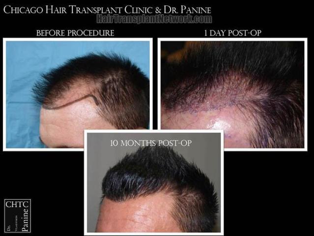 Hair transplantation surgery before and after pictures