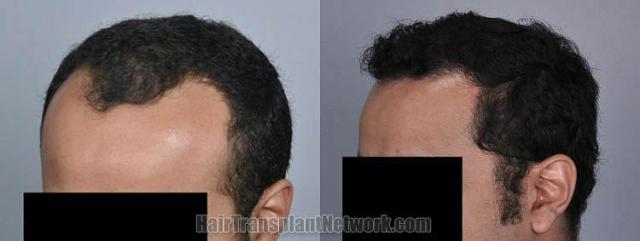 Hair restoration procedure before and after pictures