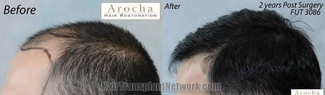 Hair transplantation surgery before and after images