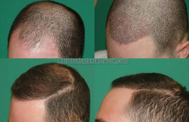 Hair transplantation surgery before and after pictures