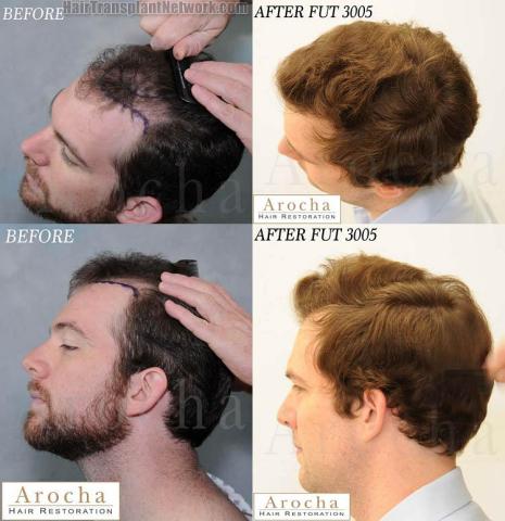 Hair transplantation surgery before and after pictures