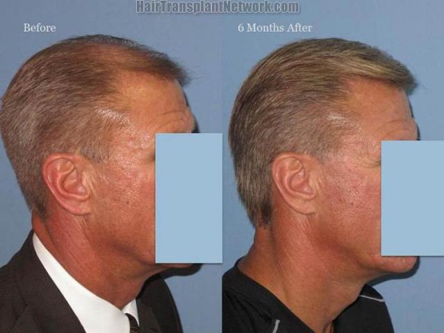 Hair transplantation surgery before and after images