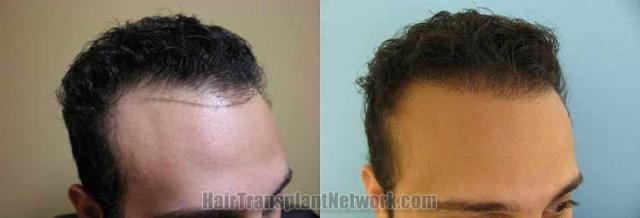 Hair restoration procedure before and after results