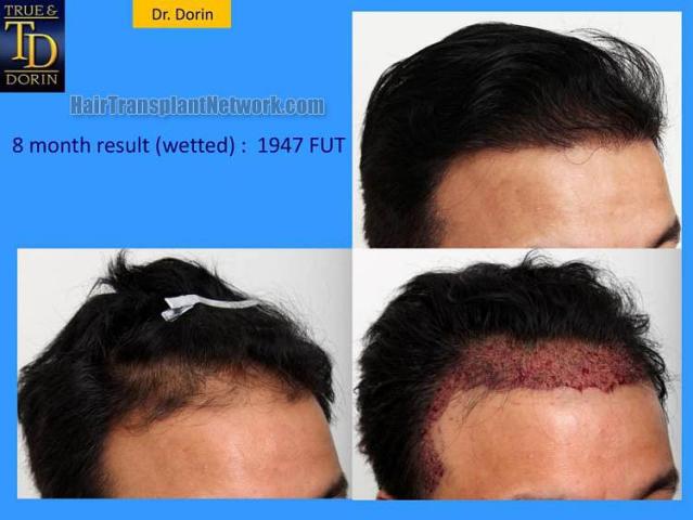 Hair transplantation surgery before and after images