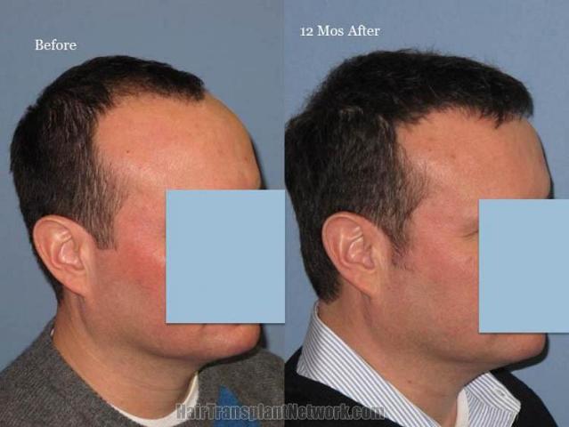 Hair transplantation surgery before and after photos