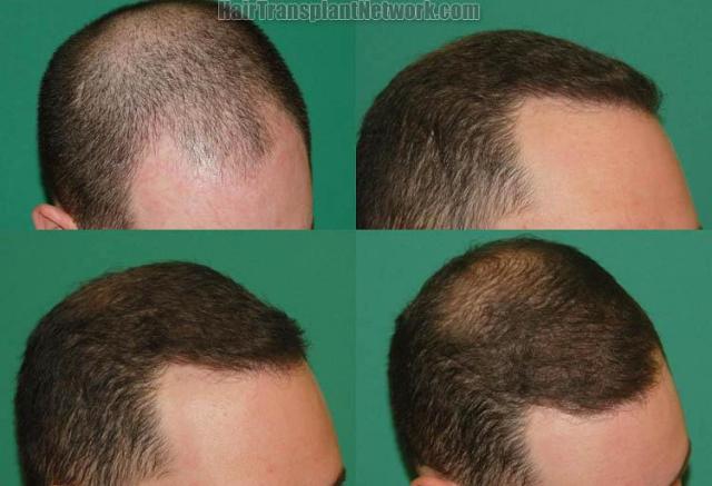 Hair transplantation surgery before and after images