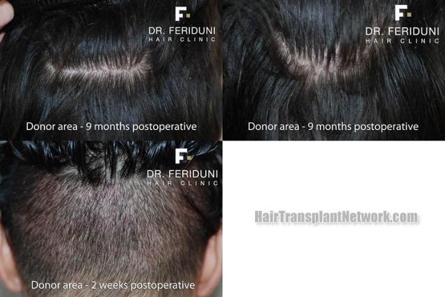 Hair restoration procedure before and after pictures