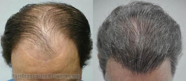 Hair transplantation surgery before and after photos