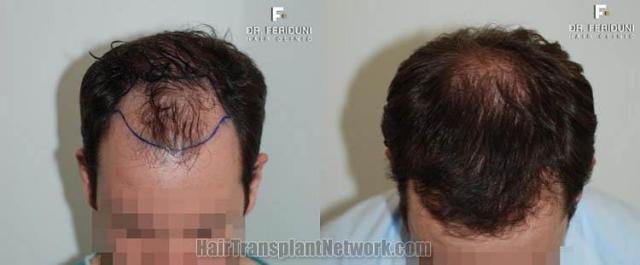 Hair transplantation surgery before and after photos