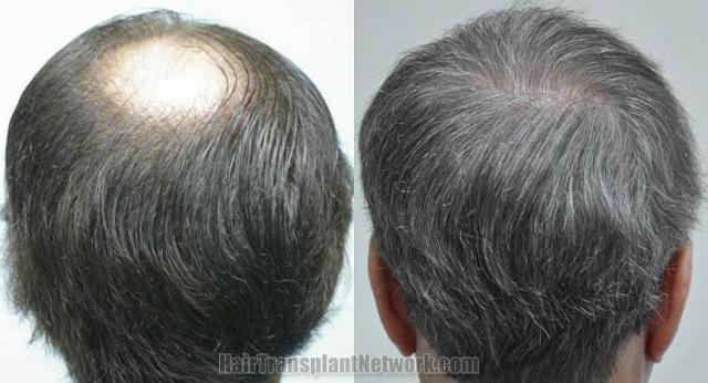 Hair restoration procedure before and after pictures