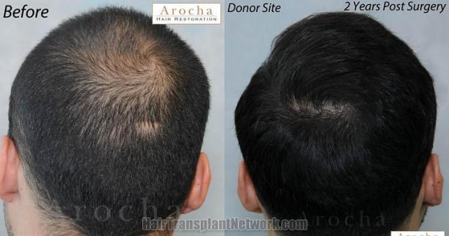 Hair restoration procedure before and after results