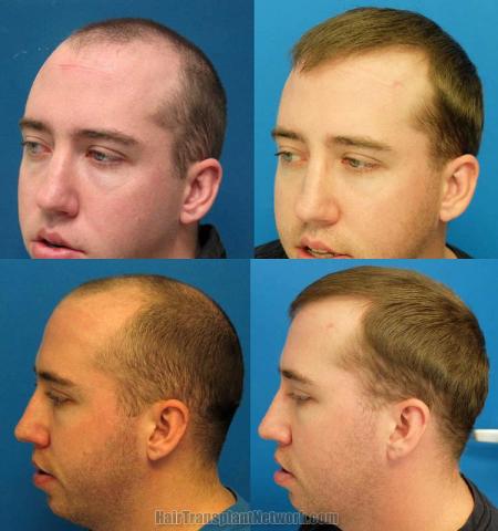 Hair transplantation surgery before and after images