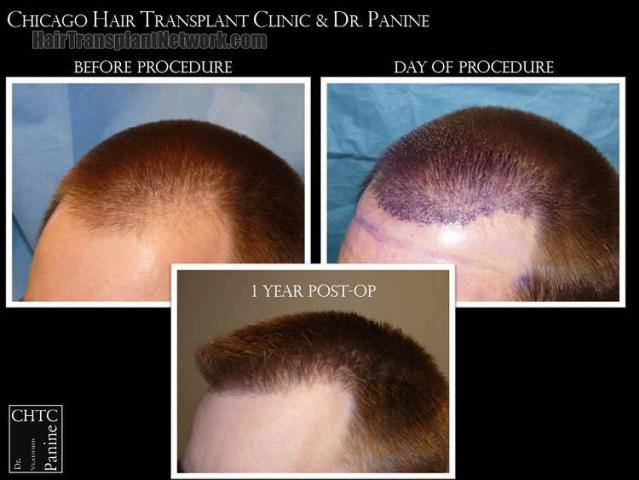 Hair restoration procedure before and after pictures