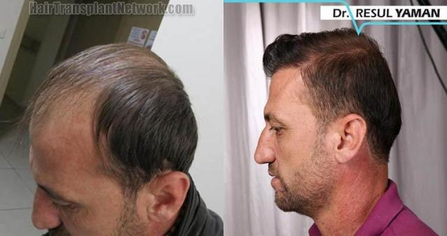 Hair restoration procedure before and after pictures