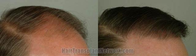 Hair transplantation surgery before and after images