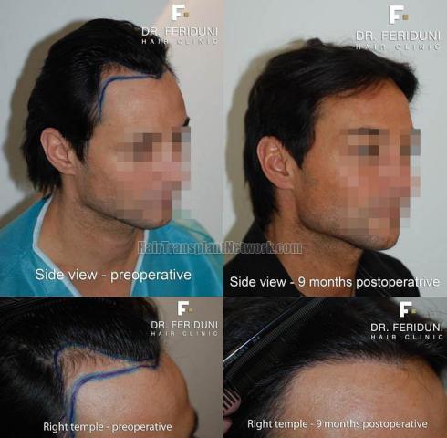 Hair transplantation surgery before and after images