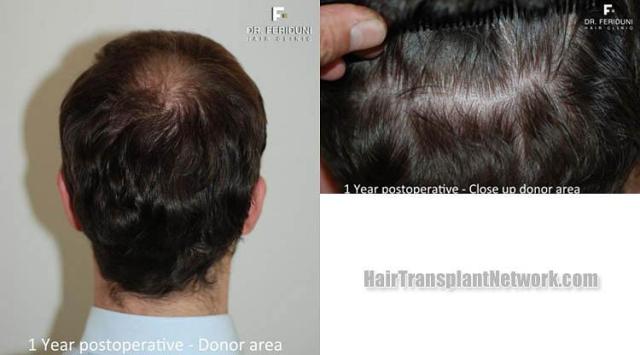 Hair restoration procedure before and after pictures