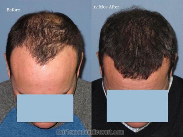 Hair restoration procedure before and after pictures