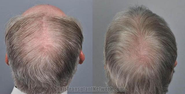 Hair transplantation surgery before and after pictures