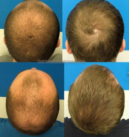 Hair transplantation surgery before and after pictures