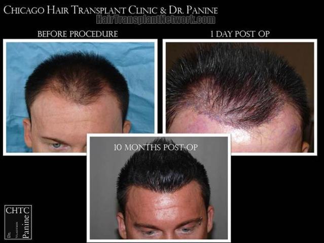 Hair restoration procedure before and after results