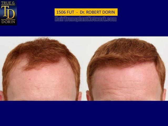 Hair transplantation surgery before and after pictures