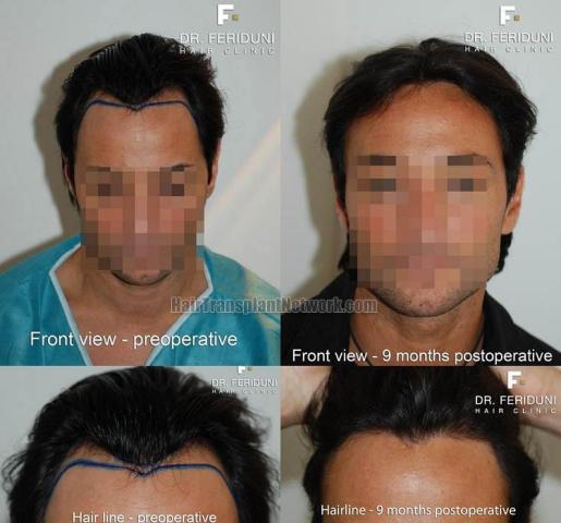 Hair restoration procedure before and after results