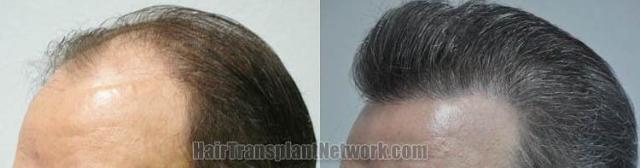 Hair transplantation surgery before and after pictures