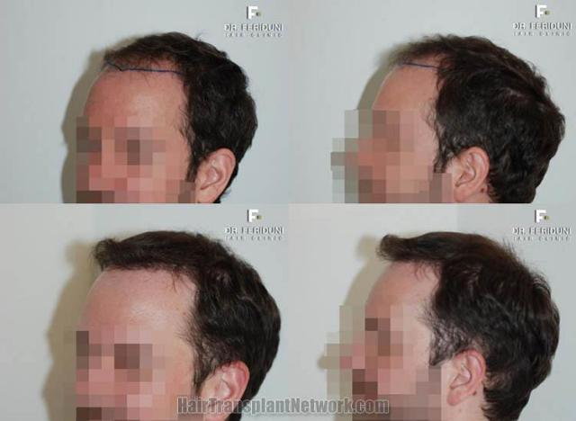 Hair transplantation surgery before and after pictures