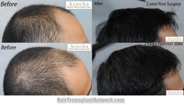 Hair transplantation surgery before and after pictures