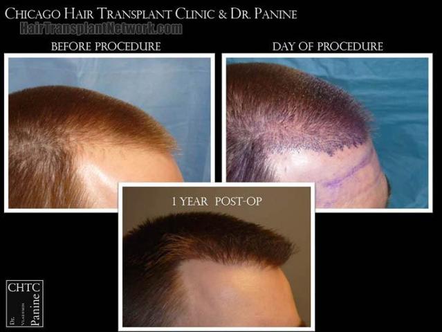 Hair transplantation surgery before and after pictures