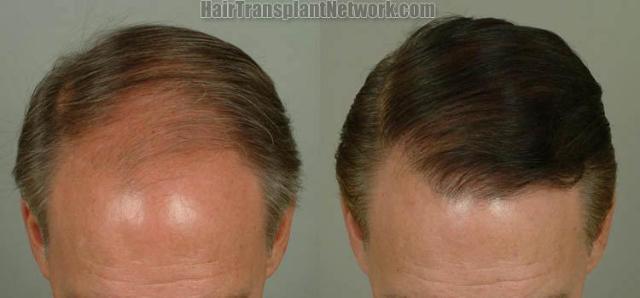 Hair transplantation surgery before and after pictures