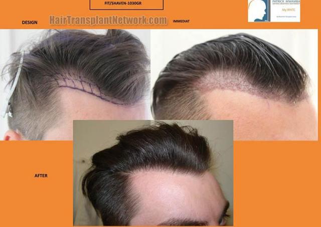 Hair transplantation surgery before and after images