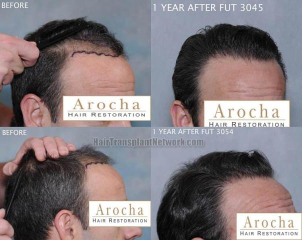 Hair transplantation surgery before and after images