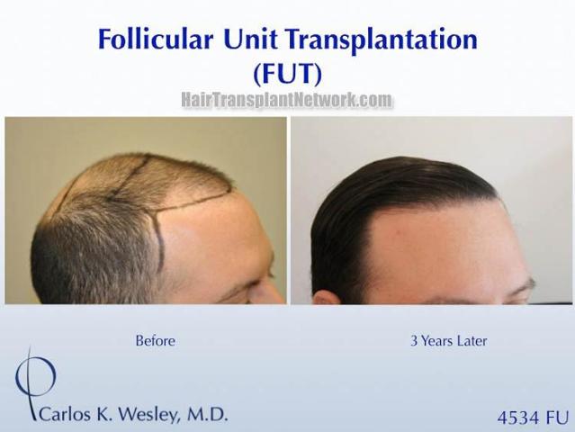 Hair restoration procedure before and after results