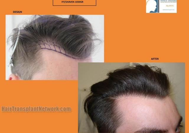 Hair restoration procedure before and after pictures