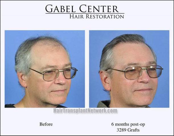 Hair restoration surgery before and after images