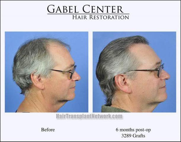 Hair restoration procedure before and after results