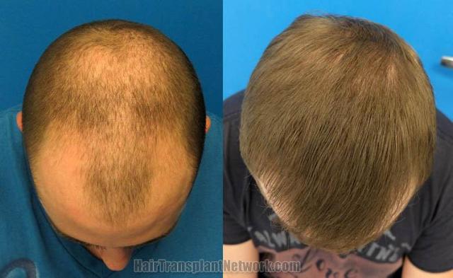 Hair restoration procedure before and after results