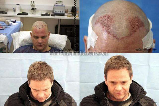 Hair restoration procedure before and after pictures