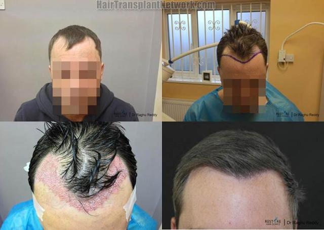 Hair transplantation surgery before and after photos